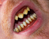 Teeth FX "Cannibale